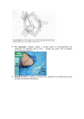 4. Por aspiración: cualquier órgano o cavidad puede ser descomprimido por
   aspiración. La naturaleza odia el vacío, siempre que existe vacío se produce
   succión (presión negativa).




5. Drenaje de tórax: su objetivo es extraer aire o líquido de la cavidad torácica para
   facilitar la reexpansión del pulmón.
 