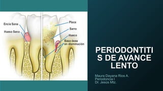 PERIODONTITI
S DE AVANCE
LENTO
Maura Dayana Rios A.
Periodoncia l
Dr. Jesús Mtz.
 