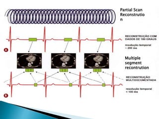 ACap 2 tc torax tecnicas e protocolos ( cap2) | PPTX