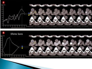 ACap 2 tc torax tecnicas e protocolos ( cap2) | PPTX