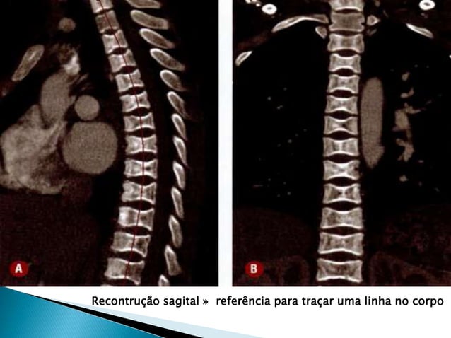 ACap 2 tc torax tecnicas e protocolos ( cap2) | PPT