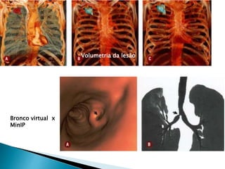 ACap 2 tc torax tecnicas e protocolos ( cap2) | PPTX