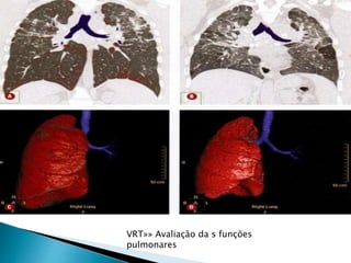 ACap 2 tc torax tecnicas e protocolos ( cap2) | PPTX