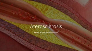 Aterosclerosis
Reyes Koyoc Antony Jeriel
 