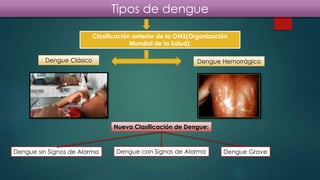 Tipos de dengue
Dengue Clásico
Clasificación anterior de la OMS(Organización
Mundial de la Salud):
Dengue Hemorrágico
Nueva Clasificación de Dengue:
Dengue sin Signos de Alarma Dengue con Signos de Alarma Dengue Grave
 