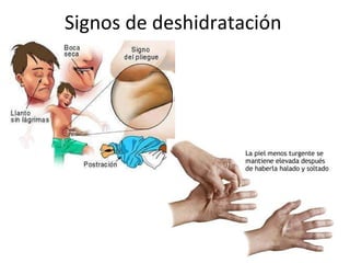 Signos de deshidratación  
