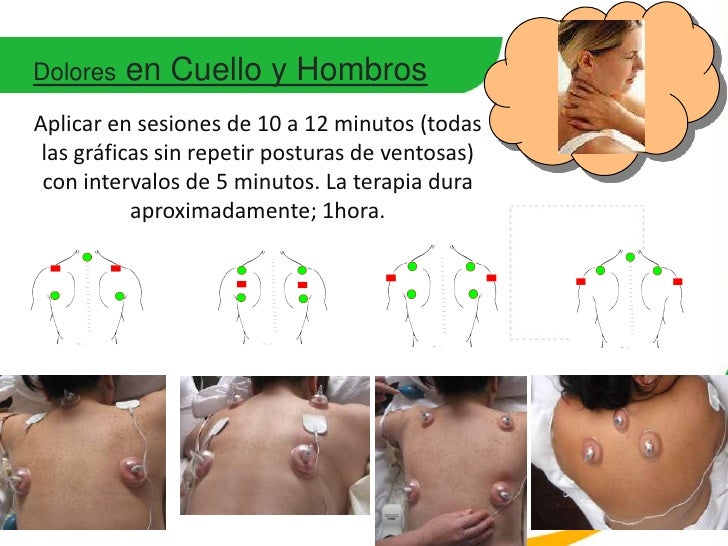 Como Poner Ventosas En La Espalda