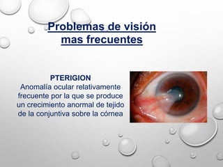 Problemas de visión
mas frecuentes
PTERIGION
Anomalía ocular relativamente
frecuente por la que se produce
un crecimiento anormal de tejido
de la conjuntiva sobre la córnea
 