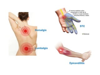 Dorsalgia
Lumbalgia
Epicondilitis
STC
 