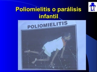 Poliomielitis o parálisisPoliomielitis o parálisis
infantilinfantil
 