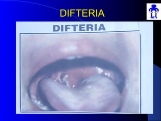 DIFTERIADIFTERIA
 