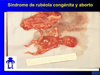 Síndrome de rubéola congénita y aborto
 