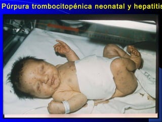 Púrpura trombocitopénica neonatal y hepatitis
 
