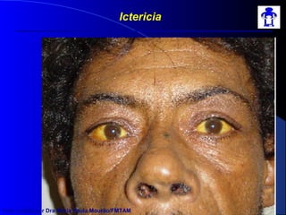 Ictericia
Foto cedida por Dra Maria Paula Mourão/FMTAM
 
