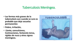 Tuberculosis Meníngea.
• Las formas más graves de la
tuberculosis aun cuando se cura es
probable que deje secuelas
permanentes
• Fiebre, irritación,
• Llanto, convulsiones,
Contracciones, fontanela tensa,
rigidez de nuca y otros signos
meníngeos.
 