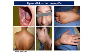 Fotos: OPS-OMS
Signos clínicos del sarampión
 