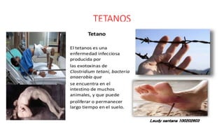 TETANOS
72
 