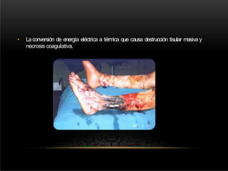• Laconversión de energía eléctrica a térmica que causa destrucción tisular masiva y
necrosis coagulativa.
 