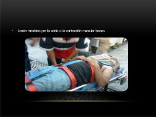 • Lesión mecánica por la caída o la contracción muscular brusca.
 