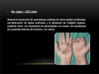 • Alto voltaje > 1000 Voltios
Abarcanla produccióndequemadurascutáneas devariosgrados combinadas
condestrucción de tejidos profundos y la afectación de múltiples órganos,
pudiendo llevar ala amputacióndeextremidades olamuerte. Se caracterizan
por presentar lesiones deentrada y de salida.
 