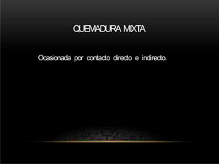 QUEMADURA MIXT
A
Ocasionada por contacto directo e indirecto.
 