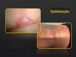 Epitelização
APRESENTAÇÃO INSTITUCIONAL
 