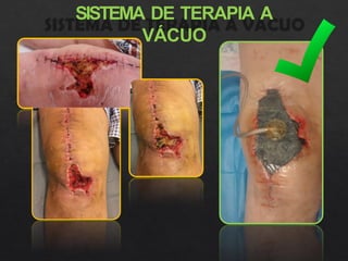 SISTEMA DE TERAPIA A
VÁCUO
 