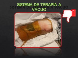 SISTEMA DE TERAPIA A
VÁCUO
 