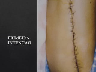 PRIMEIRA
INTENÇÃO
 