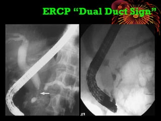 ERCP “Dual Duct Sign”
 