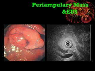 Periampulary Mass
&EUS
 