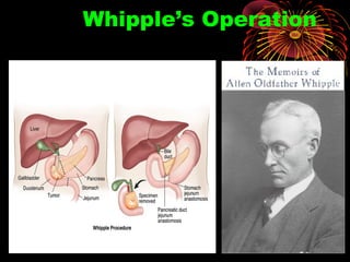 Whipple’s Operation
 