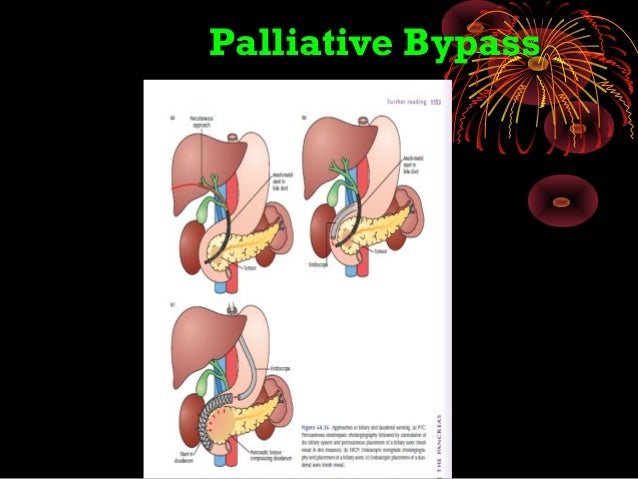 Pancreatic Carcinoma Obstructive Jaundice