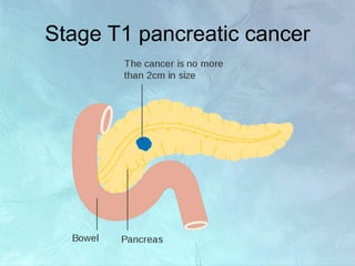 Stage T1 pancreatic cancer
 