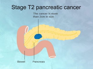 Stage T2 pancreatic cancer
 