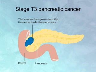 Stage T3 pancreatic cancer
 