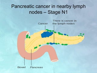 Pancreatic cancer in nearby lymph
nodes – Stage N1
 