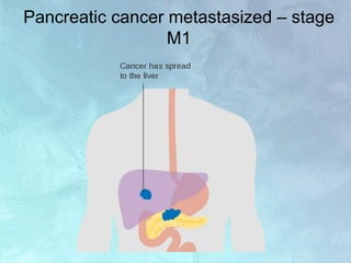 Pancreatic cancer metastasized – stage
M1
 