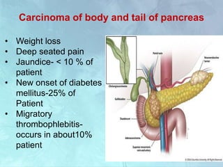 Carcinoma of body and tail of pancreas
• Weight loss
• Deep seated pain
• Jaundice- < 10 % of
patient
• New onset of diabetes
mellitus-25% of
Patient
• Migratory
thrombophlebitis-
occurs in about10%
patient
 