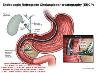 Endoscopic Retrograde
Cholangiopancreatography
• Highly sensitive
• Usually reserved as a therapeutic procedure for
biliary obstruction.
• Brush cytology and forceps biopsy for histologically
diagnosing pancreatic cancer.
• Therapeutic palliation of obstructive jaundice through
stent placement
 
