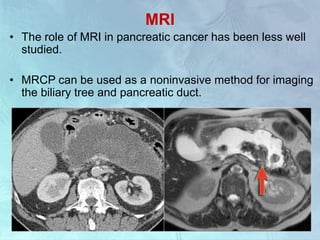 MRI
• The role of MRI in pancreatic cancer has been less well
studied.
• MRCP can be used as a noninvasive method for imaging
the biliary tree and pancreatic duct.
 