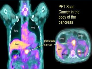 PET Scan
• Useful in detecting occult metastatic disease.
• False-positive PET scans have been reported in
pancreatitis.
• PET-CT scanning is more sensitive than conventional
imaging for the detection of pancreatic cancer.
 