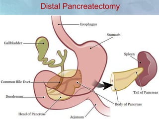 Distal Pancreatectomy
• Distal pancreatectomy is a procedure in which the tail
and/or portion of the body of the pancreas are
removed, but not the head.
• Distal pancreatectomy may be an effective procedure
for tumors located in the body and tail of the pancreas.
 