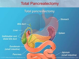 Total Pancreatectomy
• The indication for the use of total pancreatectomy is
in cases in which the tumor involves the neck of the
pancreas.
• This can either be a situation in which the tumor
originates from the neck or is growing into the neck
 