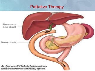 Palliative Therapy
PAIN
 Narcotic analgesics
 Narcotic analgesics
with tricyclic
antidepressants
 Antiemetics
 Endoscopic
decompression with
stents.
JAUNDICE
 Endoscopic placement
of plastic or metal
stents.
 Biliary decompression
 choledochojejunostomy
 