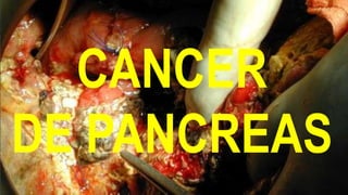 CANCER
DE PANCREAS
 