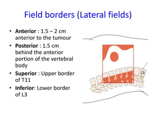 Field borders (Lateral fields)
• Anterior : 1.5 – 2 cm
anterior to the tumour
• Posterior : 1.5 cm
behind the anterior
portion of the vertebral
body
• Superior : Upper border
of T11
• Inferior: Lower border
of L3
 