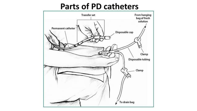 CAPD Catheters.pptx