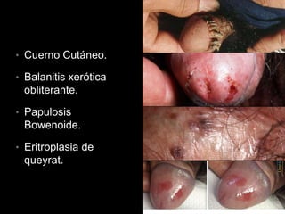 • Cuerno Cutáneo.
• Balanitis xerótica
obliterante.
• Papulosis
Bowenoide.
• Eritroplasia de
queyrat.
 