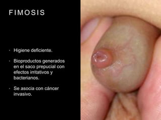 F I M O S I S
• Higiene deficiente.
• Bioproductos generados
en el saco prepucial con
efectos irritativos y
bacterianos.
• Se asocia con cáncer
invasivo.
 
